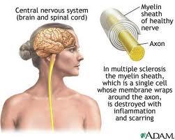 La sclerosi multipla è un infiammazione del tessuto nervoso che esita