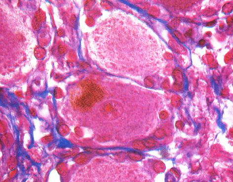 Nevroglia del SNP Cellule di Schwann