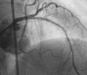 Ital Heart J Suppl Vol 4 Agosto 2003 A B C D Figura 3. Ristenosi diffusa (> 30 mm) intrastent del ramo interventricolare anteriore (diametro di riferimento 2.5 mm). A: quadro angiografico basale.