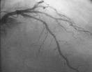 P Ortolani et al - Brachiterapia nelle ristenosi intrastent A B C D E Figura 5. Duplice ristenosi intrastent del ramo interventricolare anteriore. A: quadro angiografico basale.