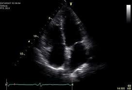 Bulbo aortico ed aorta ascendente nei limiti; Non immagini riferibili