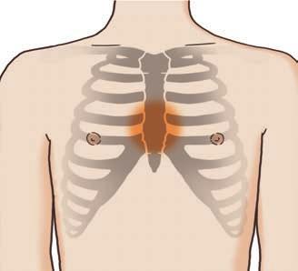 4 Emergenze Compressioni toraciche e respirazione artificiale Collocare la persona su una superficie piana e rigida in posizione supina prire gli indumenti sul torace Localizzare l esatto punto di