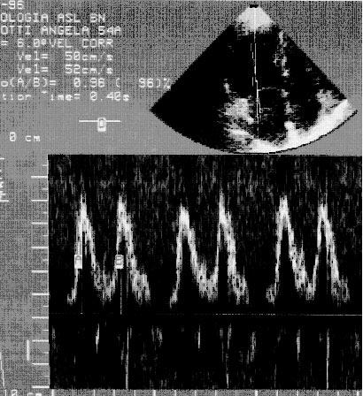 9. BADANO L ET AL. Effetti dell invecchiamento sugli indici Doppler di funzione diastolica del ventricolo sinistro in soggetti normali. Ecocardiografia 1991; 4: 23-31 10. OH JK ET AL.