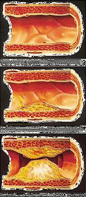Arteriopatie degli arti inferiori: aterosclerosi L'aterosclerosi è una malattia cronica delle arterie
