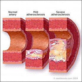 Aterosclerosi: evoluzione della placca La PLACCA può: rompersi e embolizzare; ulcerarsi ed essere complicata