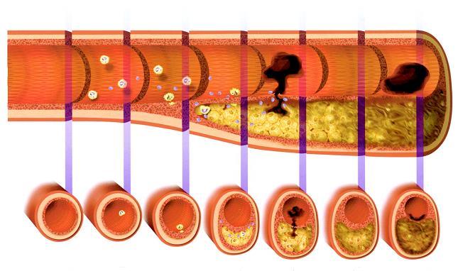 Aterosclerosi: evoluzione della placca Trombosi Aterosclerosi Angina instabile Infarto Stroke