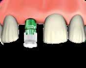 3 FACILITY TRANSFER (TECNICA CUCCHIAIO CHIUSO) Posizionare accuratamente il transfert per impronta nell impianto e serrare la vite utilizzando la chiave protesica 1.