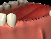 APPLICAZIONI CLINICHE Le griglie sono indicate in tutti i casi di rigenerazione ossea guidata, specialmente in prospettiva di