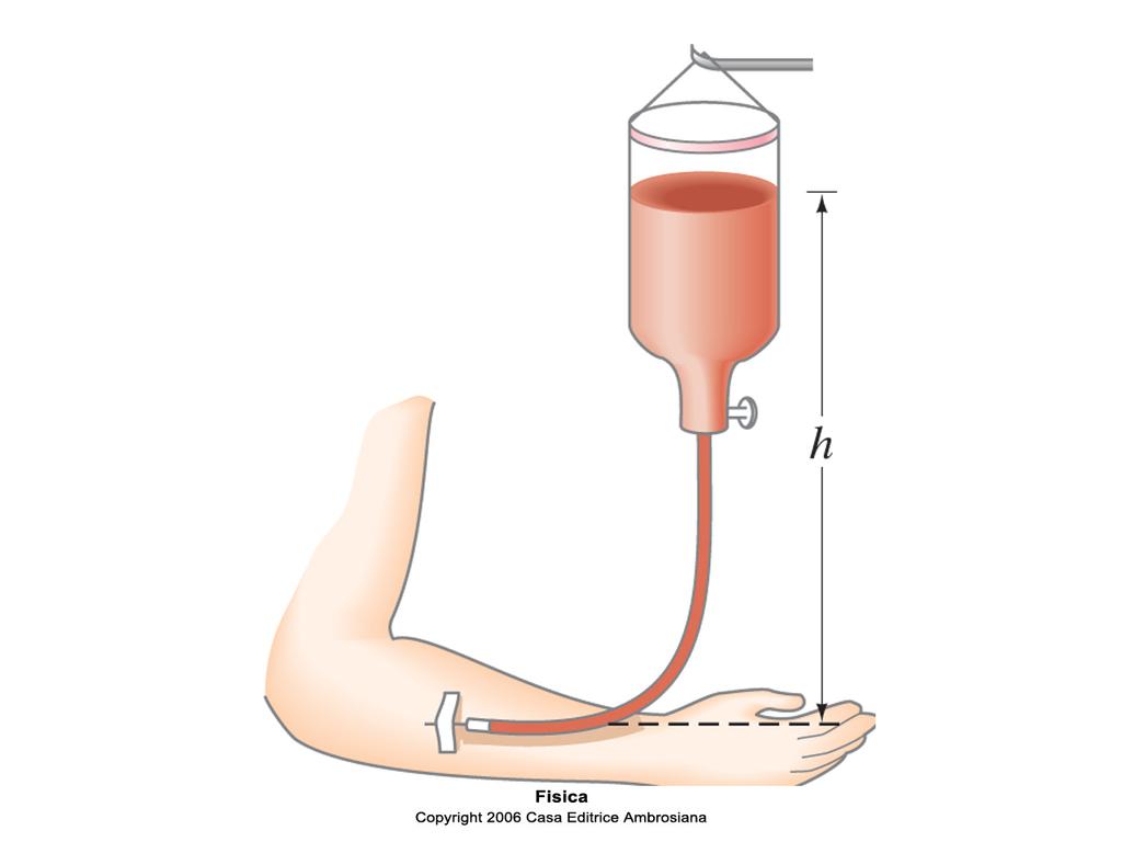 LA FLEBO Per effettuare una terapia infusiva, a che altezza va sistemato il