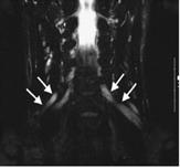 Neuropatie disimmuni croniche: Polineuropatia demielinizzante