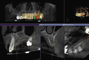 Abutment personalizzati su base adesiva TiBase e da grezzi per abutment in titanio La progettazione di abutment personalizzati in ossido di zirconio per la cementazione su