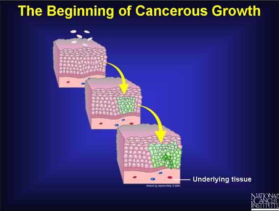 Questo graduale incremento del numero di cellule capaci di moltiplicarsi crea una massa tessutale in crescita: il tumore (Fig. 2).