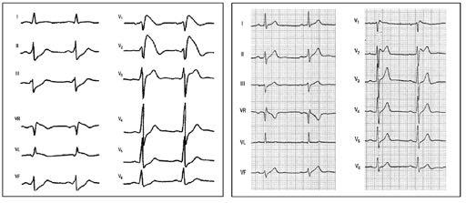 Pattern ECG della sindrome di