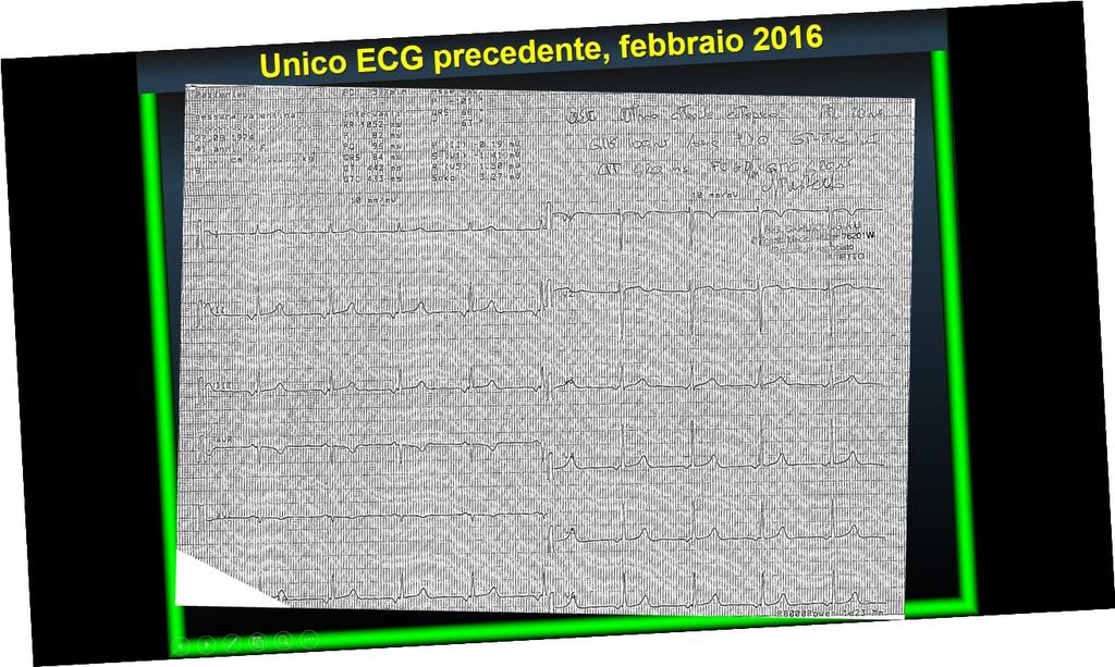 Unico ECG precedente, febbraio 2016 Ritmo
