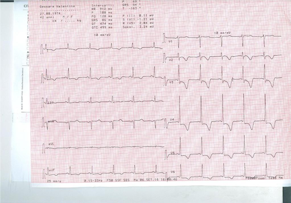 ECG 6 settembre, tre settimane dopo la sincope 1) 2) 3) 4) Qt 500 Fc 65, Qtc 520 5)