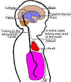 La derivazione ventricolo-peritoneale Questa procedura consiste nel posizionare un sottile catetere di drenaggio (in silicone) che permette il deflusso del liquor dai ventricoli cerebrali alla cavità