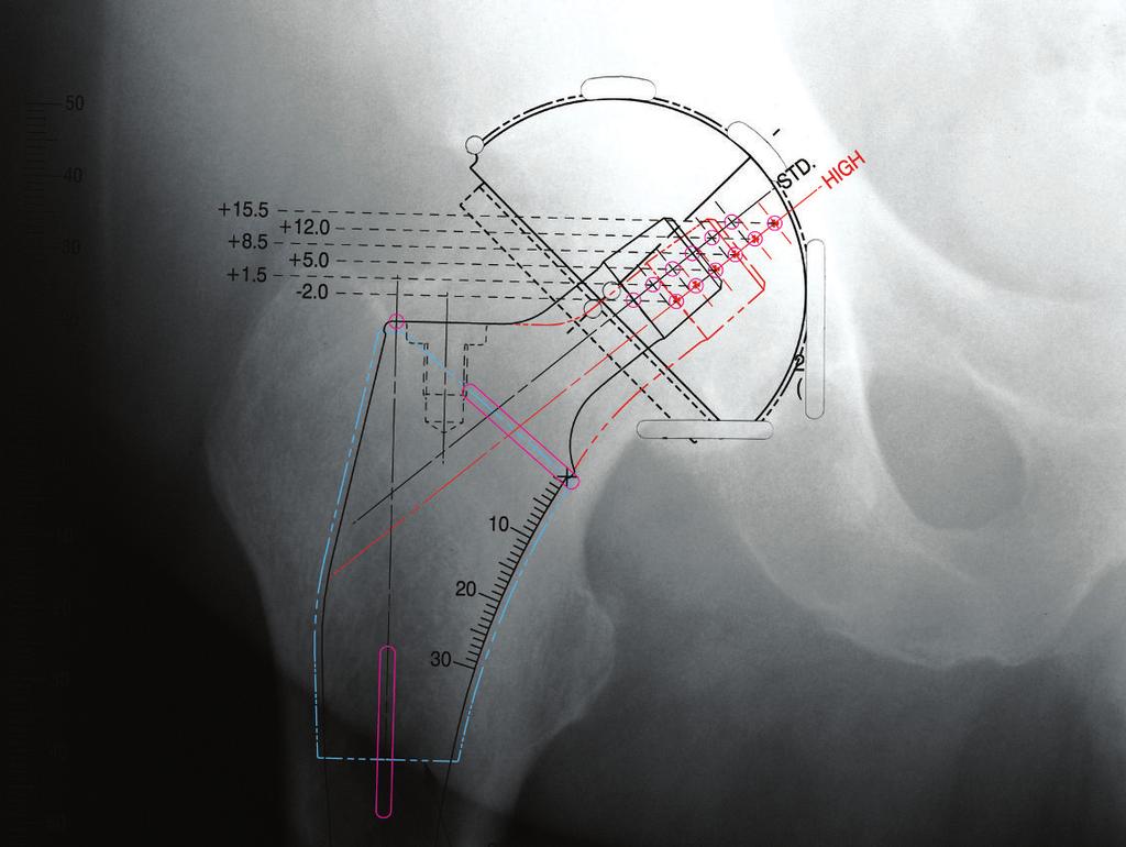 Scelta dello stelo femorale Lo stelo a conservazione ossea TRI-LOCK è studiato per consentire di ottenere uno stretto contatto corticale prossimale della corticale endostale mediale e di quella