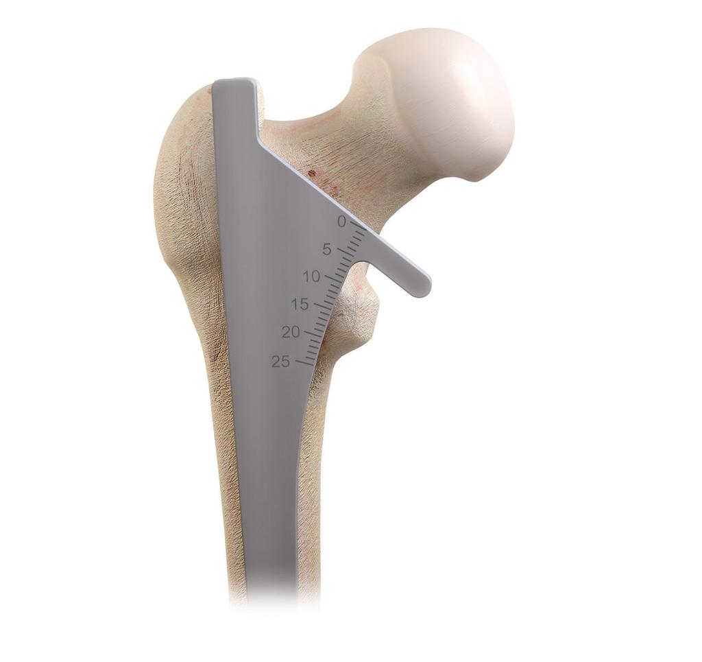 Osteotomia del collo Allineare la guida di resezione del collo con l'asse lungo del femore.
