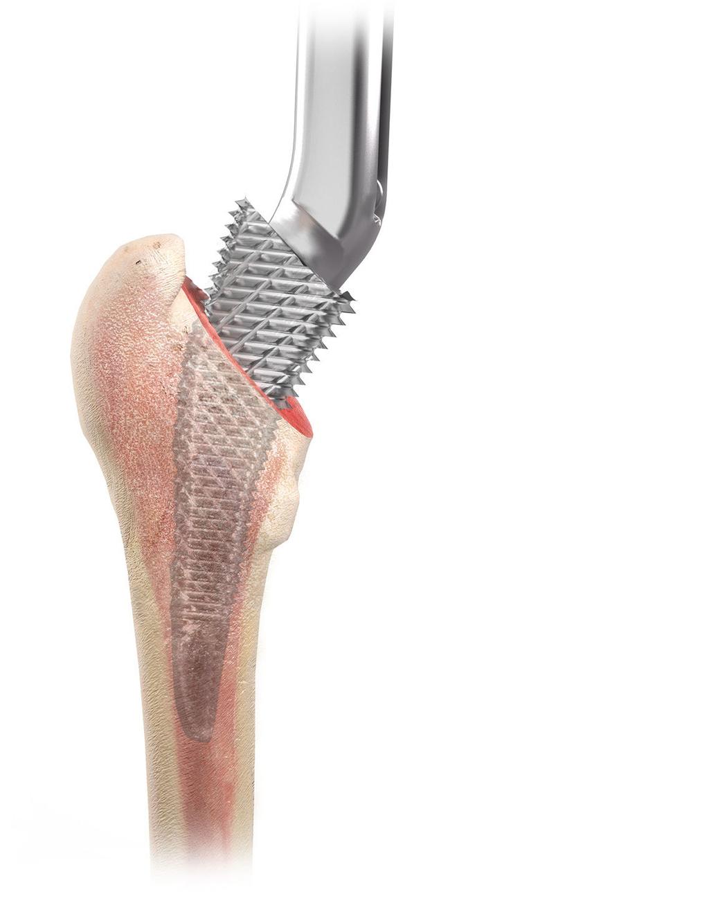 Preparazione del canale femorale Lo stelo TRI-LOCK a conservazione ossea offre diverse impugnature per broccia che consentono diversi approcci chirurgici per la protesizzazione dell'anca.