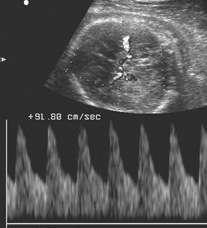 Primigravida FIVET 33 anni Gravidanza bigemina bicoriale + mola vescicolare Ricoverata per controlli intensivi Riferisce MAF assenti di un gemello dal giorno