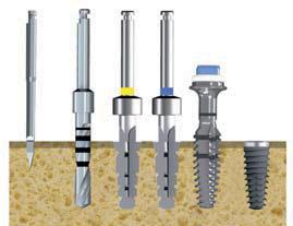 IMPIANTI E INDICAZIONI PROCEDURE CHIRURGICHE K-CORE V2 Ø 3.8 * 1 2 3 Legenda: 1 fresa iniziale 2 fresa Ø 2 mm 3 4 5 inserimento impianto 4 5 N.B.