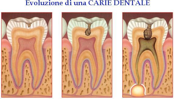 organica che costituisce il dente, creando lesioni cavitate.
