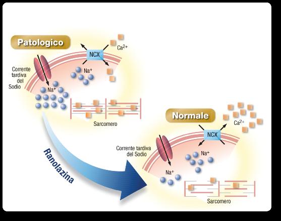 ALGORITMO TRATTAMENTO ANGINA CRONICA ANMCO/GICR-IACPR/GISE Ranolazina inibisce in maniera selettiva la corrente tardiva del sodio nel miocardiocita ischemico, senza alterare frequenza cardiaca e