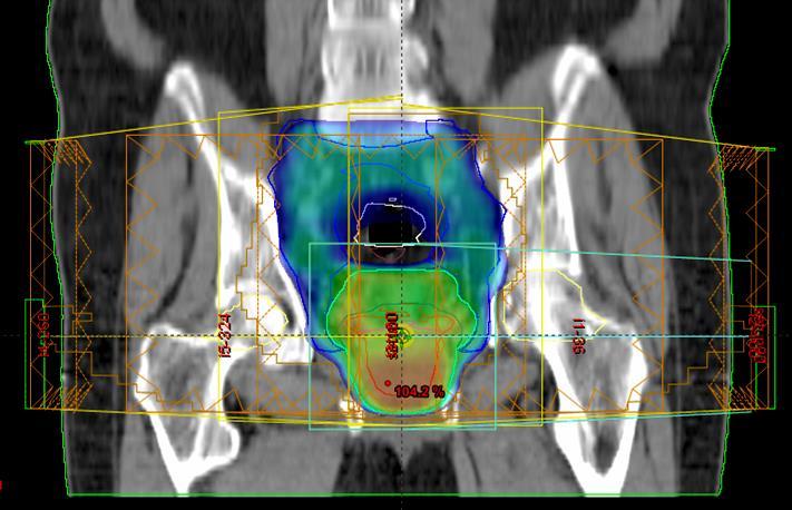 Intensity Modulated RadioTherapy with Simultaneous Integrated Boost (IMRT-SIB)