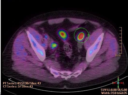 negative Endocoil-MRI & choline-pet: