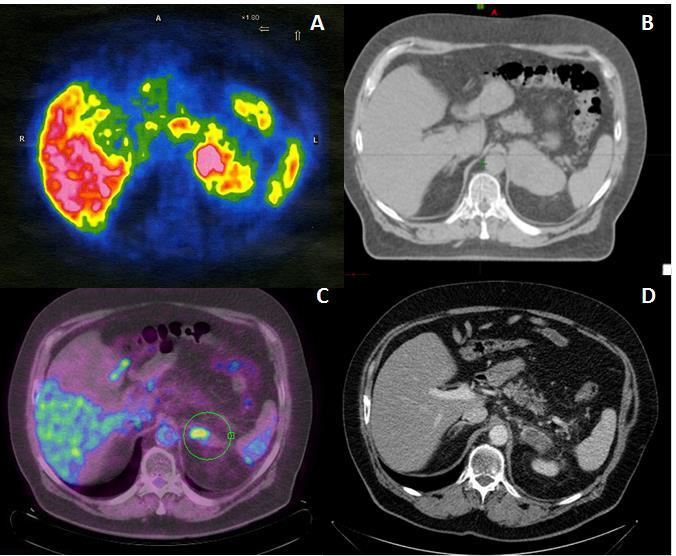 Figure 1: A) choline PET (A) and CT scan (B) performed before radiotherapy, showing an enhancing left