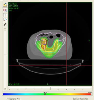 .) Dose Visualization in all plan and modalities DVH Calculation Dose summation and subtraction