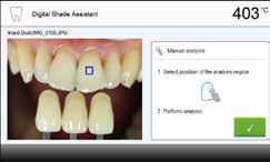 Il dente da analizzare viene comparato dal software con i denti della scala colori di riferimento.