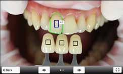 7. Controllo (correzione) delle codifiche Se le codifiche sui denti campione della scala colori non possono essere riconosciute in modo inconfutabile, appare la seguente visualizzazione.