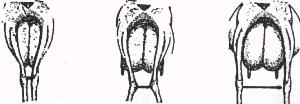 Difetti di mantello (tollerati) - 11 Gravi difetti di mantello 1 5: base cisterna alt.