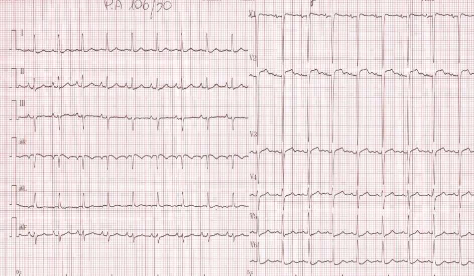 Cardiomiopatia dilatativa post terapia con antracicline L ECG in caso di