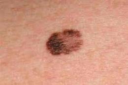 MELANOMA: TREND NEL PERIODO 2.