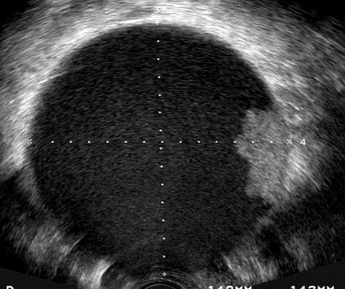 BRCA 1, BRCA2 E NEOPLASIA