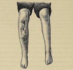 Osteomielite della tibia, con massiccio involucro