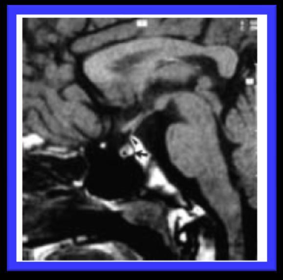 iperintensa della neuroipofisi (freccia) Sezione RMN sagittale di un soggetto con diabete insipido (a-b).