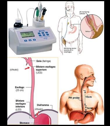 più importante che può essere ottenuta dalla ph-metria è la presenza di una relazione temporale tra il reflusso acido e l insorgenza dei sintomi [27].