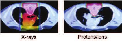 4: Piano di trattamento per un tumore al midollo ottenuto dal PTCRI di Oxford (Particle Therapy Cancer Research Institute) caratterizzare questa grandezza si introduce il parametro denominato Linear