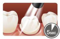 Cementazione di Ponti e Corone Preparazione del dente 6 7 Applicazione del bonding.