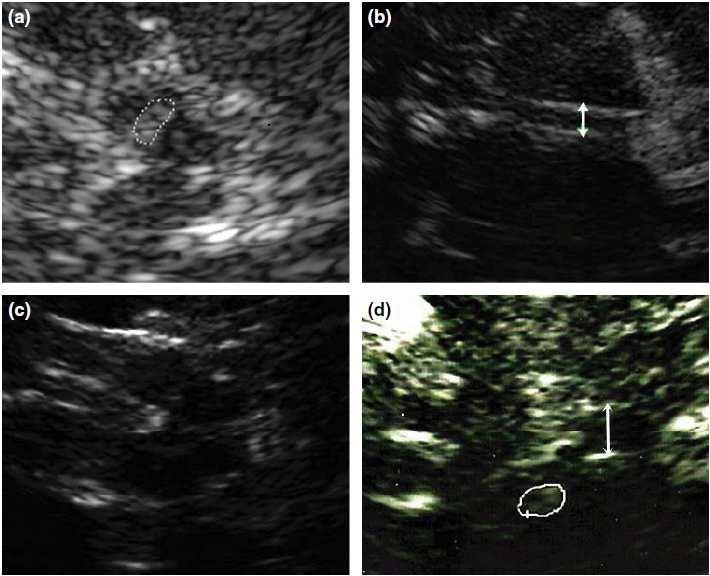 Among the patients with PSP-RS and PSP-P, three (14%) and eight (73%) patients had a hyperechogenic SN (P = 0.