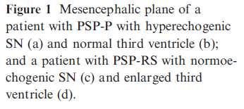 Uni- or bilateral hyperechogenicity of the LN was observed in 67% and 36% of patients with PSPRS and PSP-P, respectively (P =