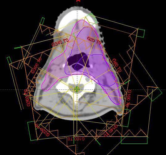 Dalla 3D alla IMRT ASPETTATIVE Alta conformazione