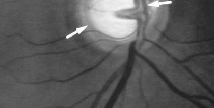 Uno stato di sofferenza della retina, dll delle vie di conduzione o di dei centri corticali ad esse collegati, si manifesta con alterazioni del campo visivo; la stimolazione della retina, allorché