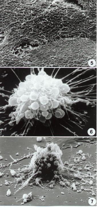 Apoptosi delle cellule epiteliali (I) 5. Cellula epiteliale normale (piatta) 6-7.