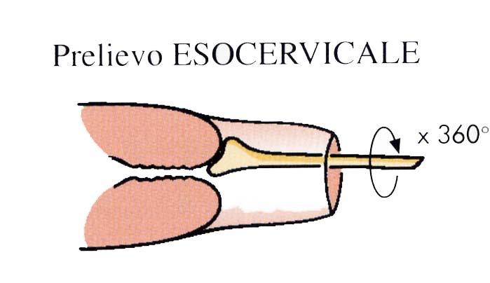 Pap Test con allestimento convenzionale Il prelievo esocervicale viene effettuato per primo la sede del prelievo esocervicale deve essere la GSC giunzione squamo-colonnare) utilizzare la spatola di