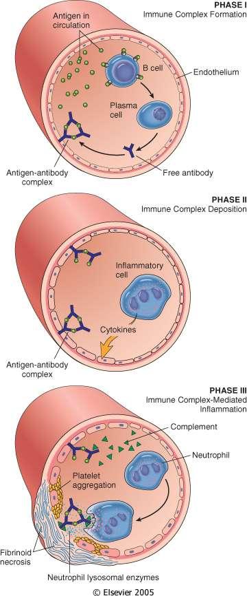 Tre fasi sequenziali nella ipersensibilità di tipo III, da immunocomplessi 1.