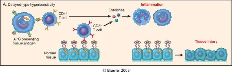 Ipersensibilità ritardata mediata da T CD4+ Al primo contatto Ag, le cellule T CD4+ identificano i peptidi-mhc classe II su APCs.